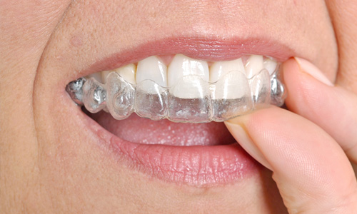 Invisalign Procedure New Tray