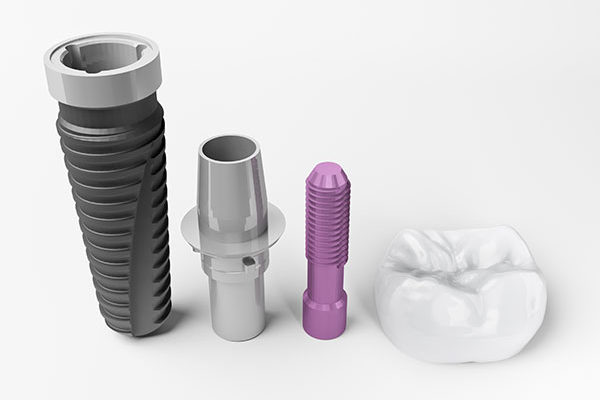 dental-implant-concept-600x400.jpg