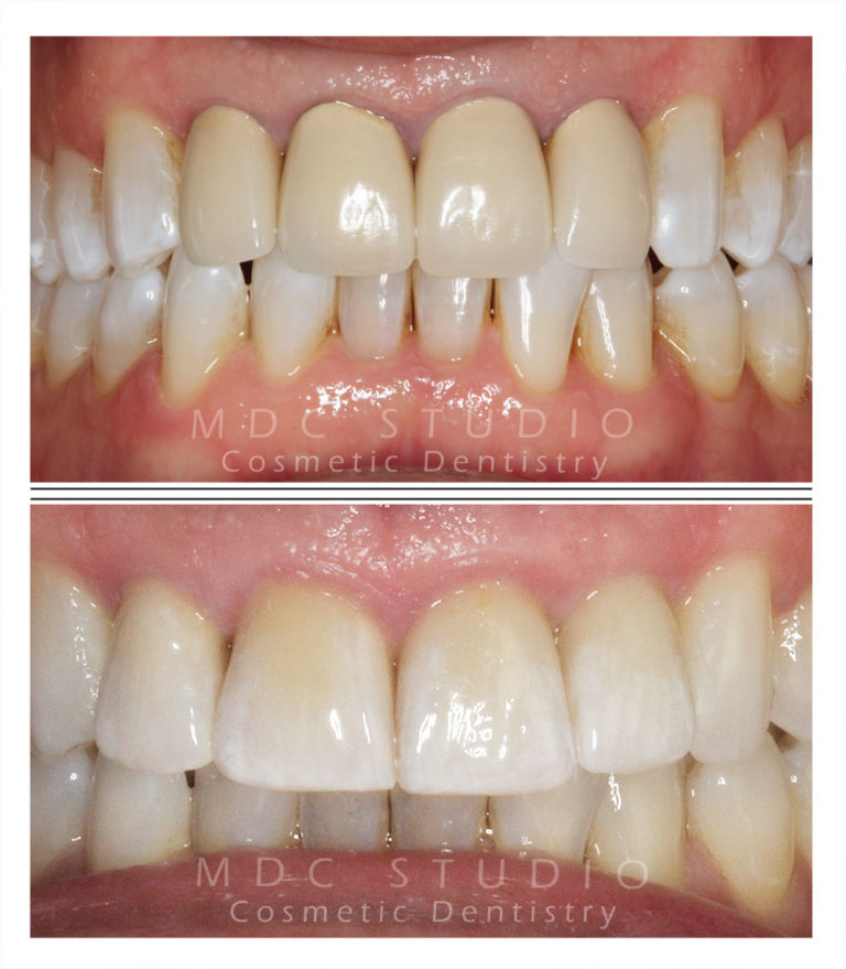 Manhattan Dental Smile Gallery 15 Manhattan Dental Care