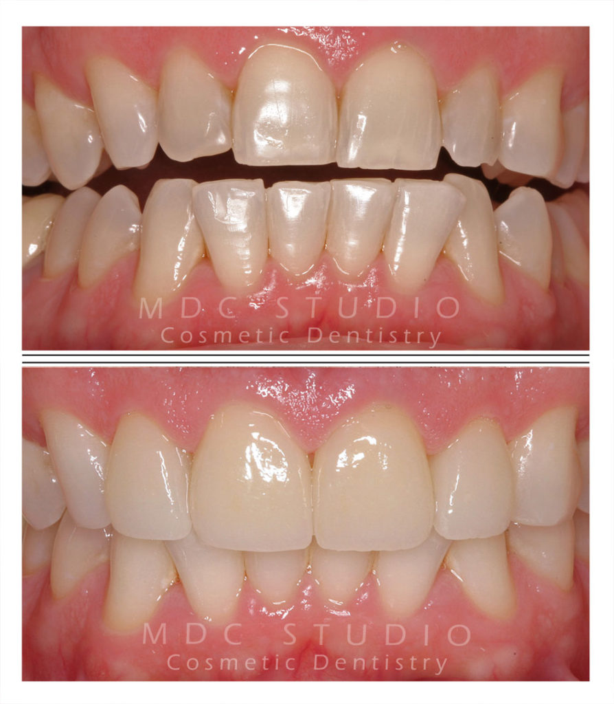 Manhattan Dental Smile Gallery 19 Manhattan Dental Care