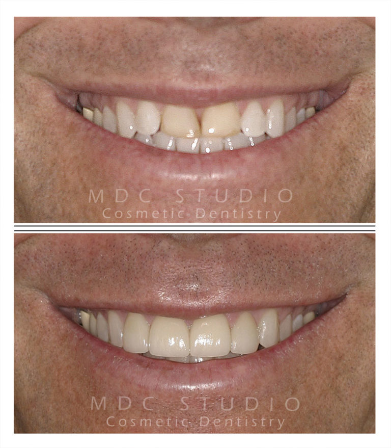 Manhattan Dental Smile Gallery 23 Manhattan Dental Care