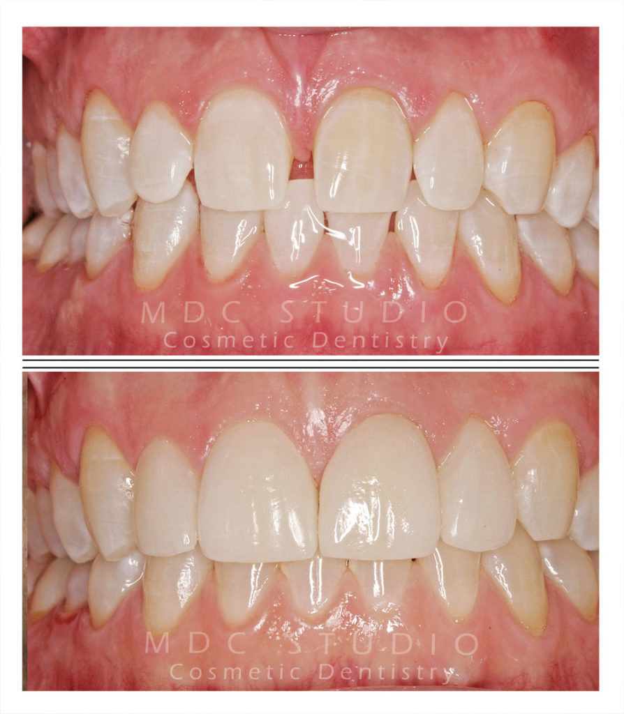 Manhattan Dental Smile Gallery 24 Manhattan Dental Care Manhattan Dental Smile Gallery 24 Manhattan Dental Care