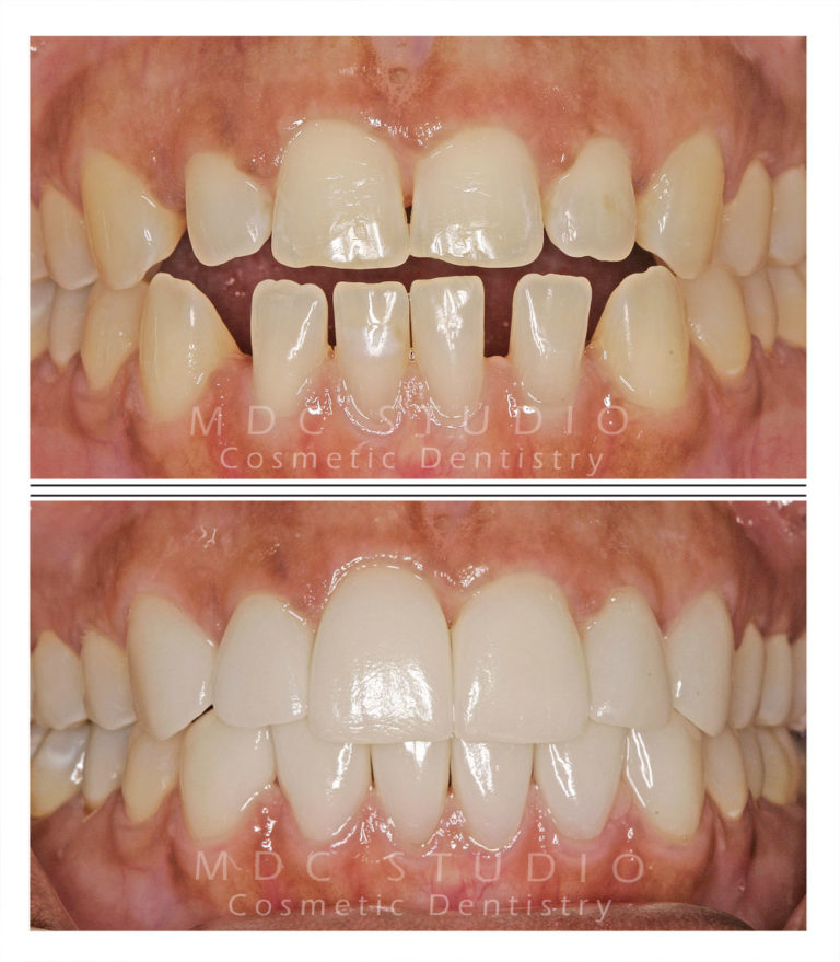 Manhattan Dental Smile Gallery 35 Manhattan Dental Care