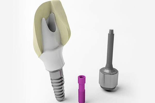 Dental Implants Front Tooth Implant 1