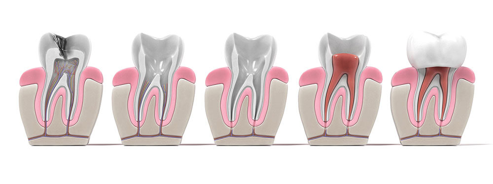 Root Canal Procedure