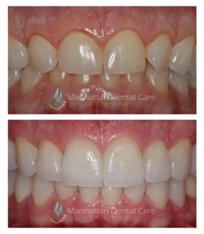 Porcelain Veneers Before and After 1