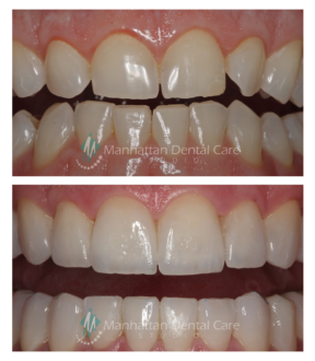 Porcelain Veneers Before and After 2