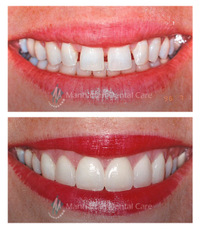 Porcelain Veneers Before and After 3
