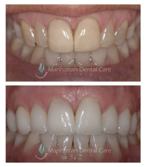 Before and After Esthetic Crowns 3