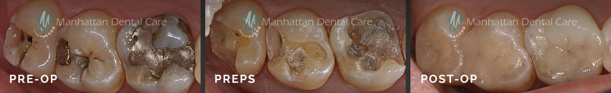 Before and After Dental Crown Manhattan Beach, CA