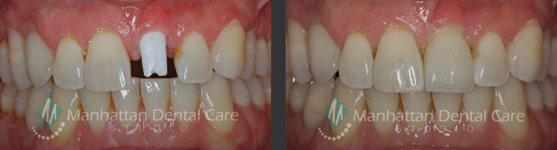 Before and After Dental Implant