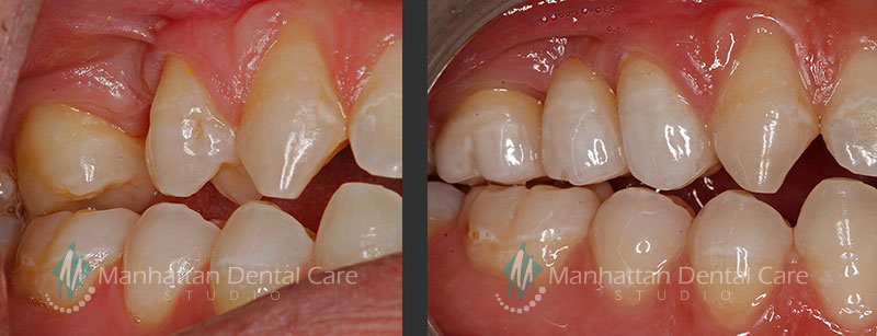 Manhattan Beach Dental Bridge Before and After