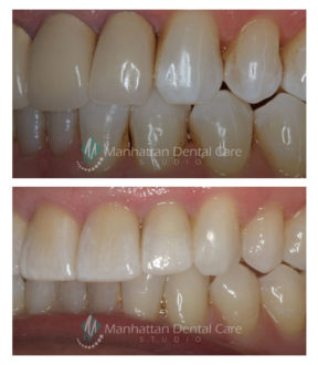 Esthetic Crowns Before and After 1