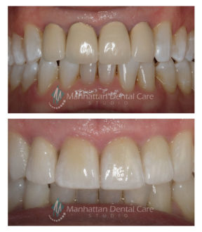 Esthetic Crowns Before and After 2