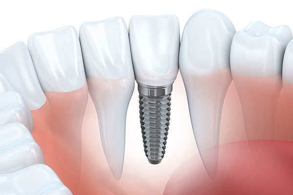 Manhattan Beach Dental Implant Concept