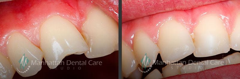 Esthetic Dental Bondings Before and After