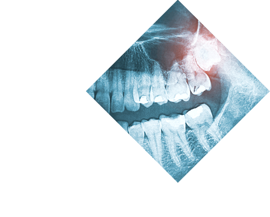 Tooth Extractions Wisdom Tooth X-Ray