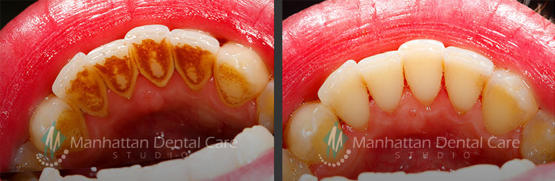 Periodic Cleanings Before and After