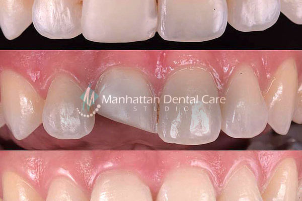 Composite Veneer to Porcelain Veneer