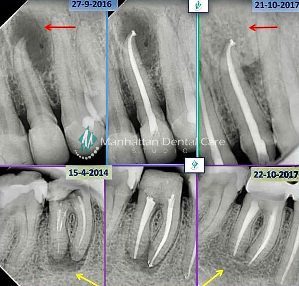 Root Canals RCT X-Rays