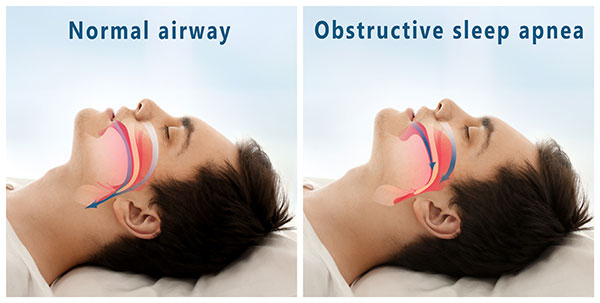 Sleep Apnea Airway Concept