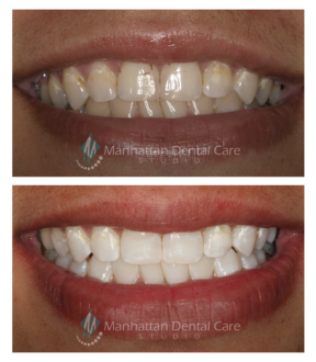 Manhattan Beach Teeth Whitening Before and After 1