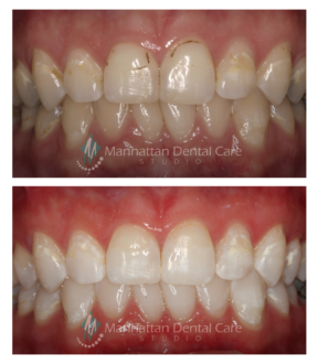 Manhattan Beach CA Teeth Whitening Before and After 2