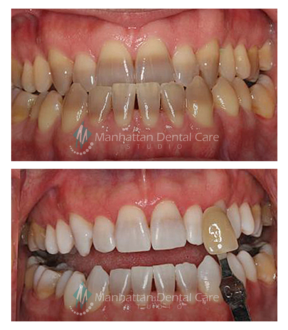 Teeth Whitening Before and After 3