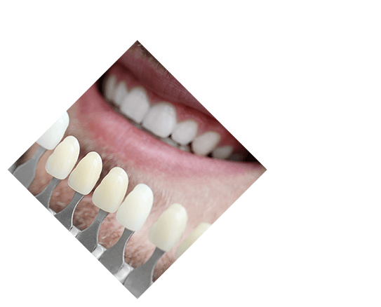 Teeth Whitening Manhattan Beach CA