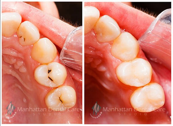 Tooth Colored Fillings Before and After