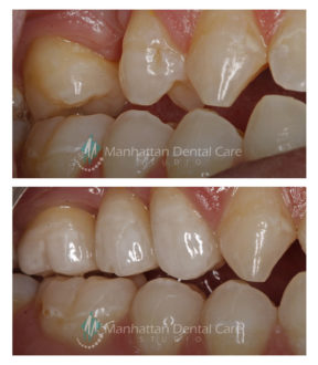 Dental Bridge Before and After