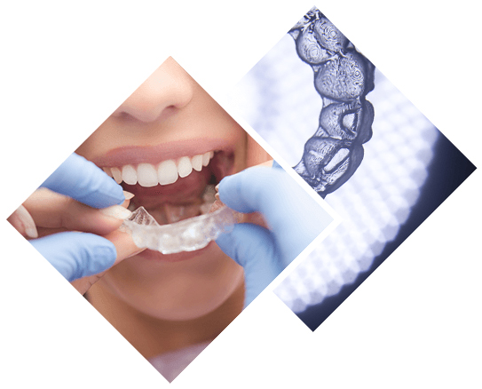 5 Reasons to Consider Invisalign Over Braces