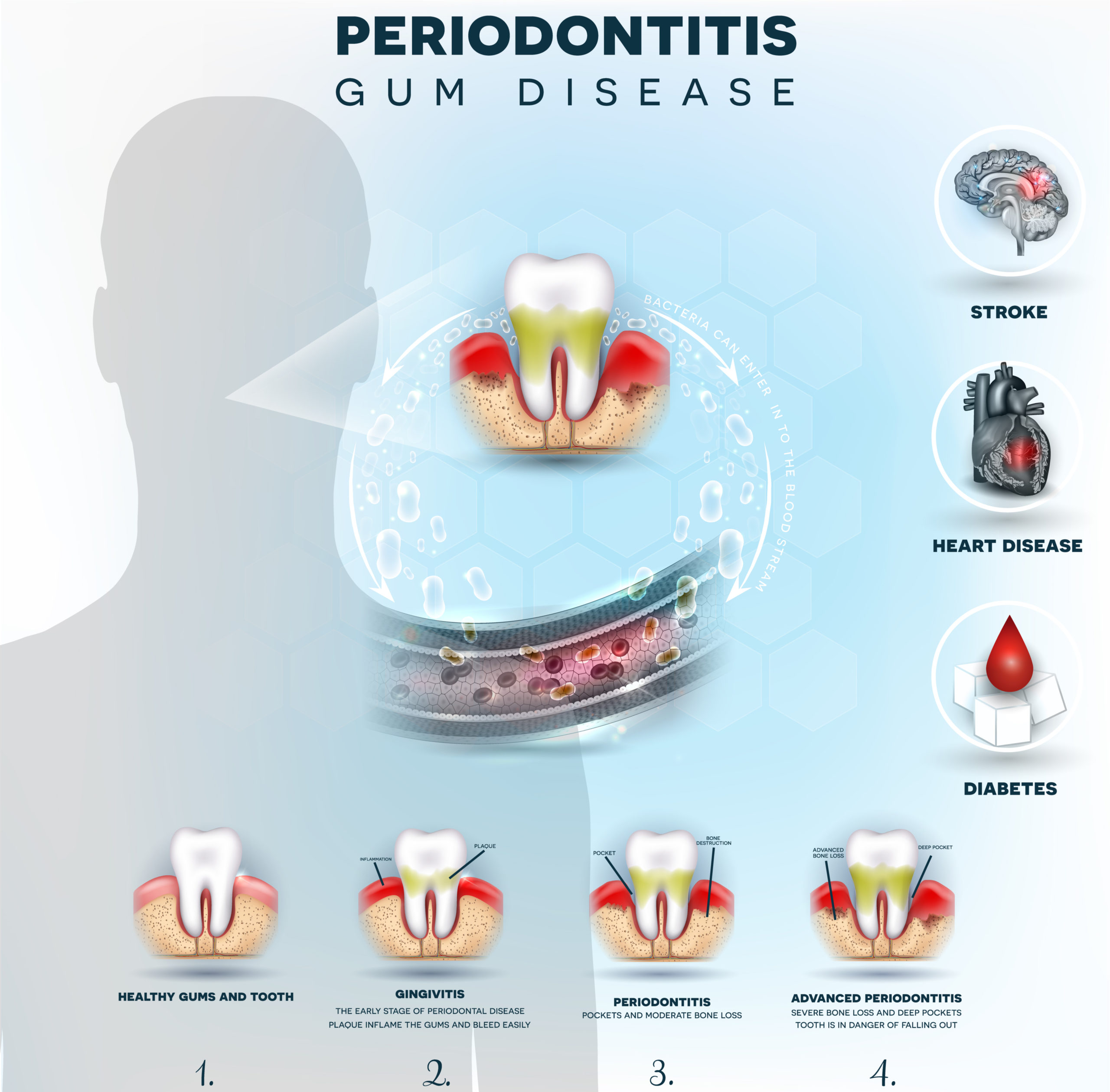 Periodontitis - Gum Disease