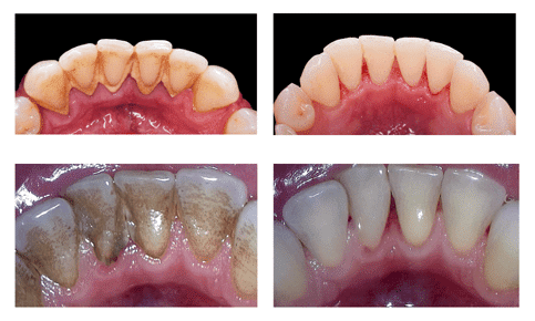 Gum disease before and after photos