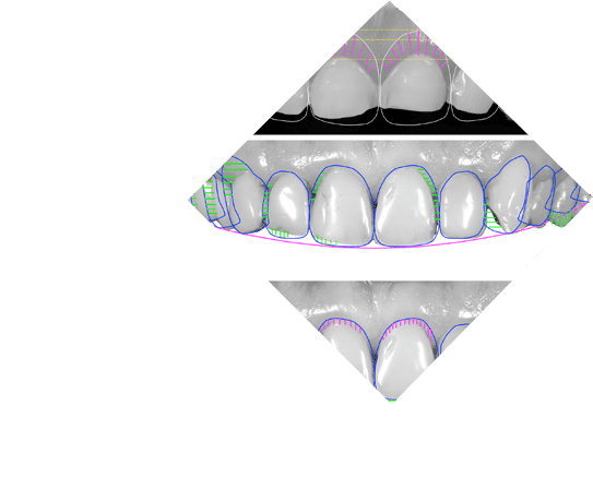 Porcelain Veneers